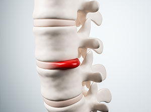 victim of auto accident injuries in Sacramento suffering from herniated disc