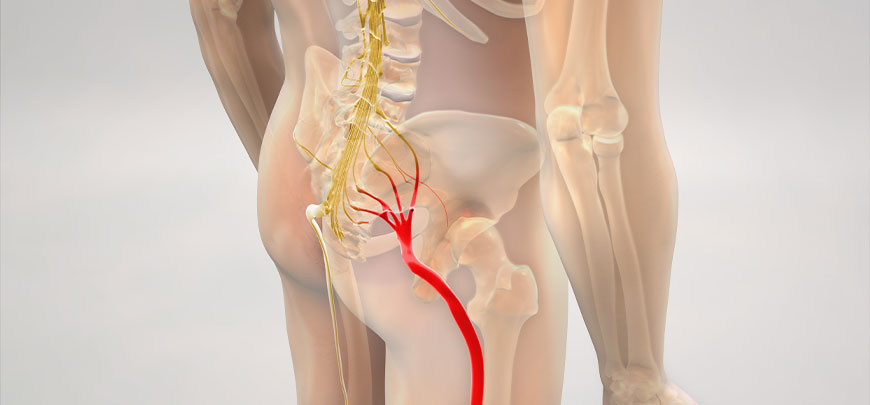 patient needing sciatica treatment in Sacramento after a car accident