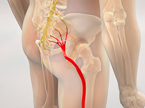 victim of auto accident injuries in Sacramento suffering from sciatica